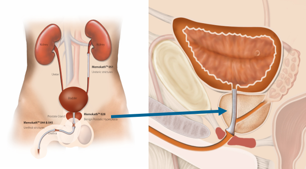 prostate-placement