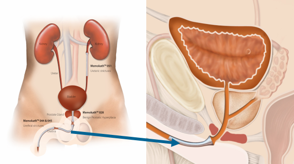 urethral-placement