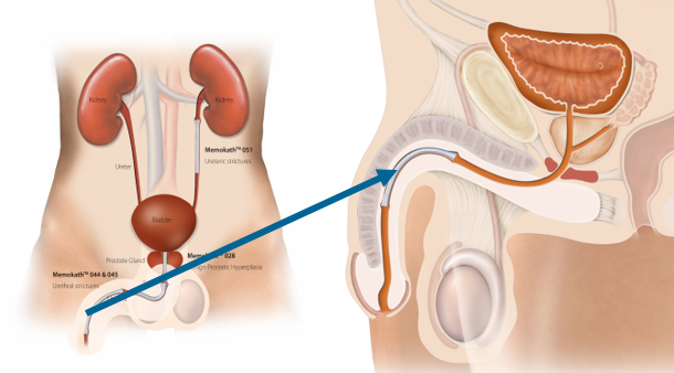 bulbar-urethral-placement