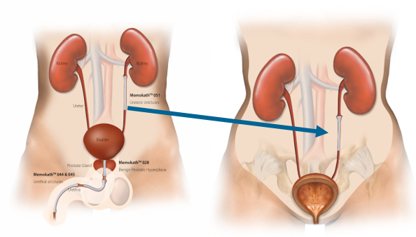 ureter-placement